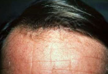 Hair Loss Treatment - Dermacare